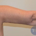 Arm Lift Before & After Patient #501