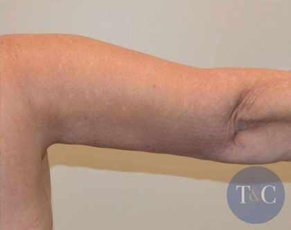Arm Lift Before & After Patient #501