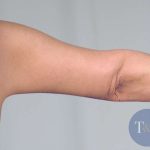 Arm Lift Before & After Patient #506