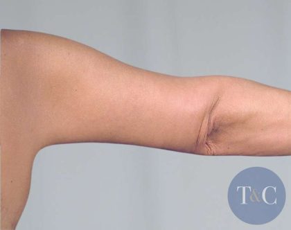 Arm Lift Before & After Patient #506