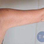 Arm Lift Before & After Patient #511