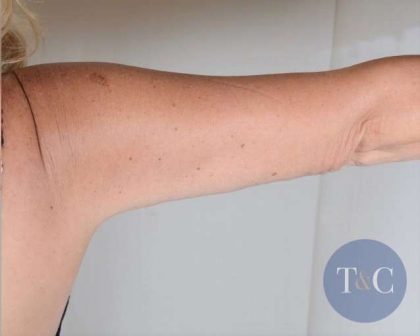 Arm Lift Before & After Patient #511