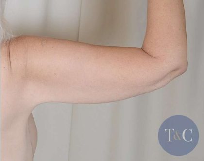 Arm Lift Before & After Patient #516