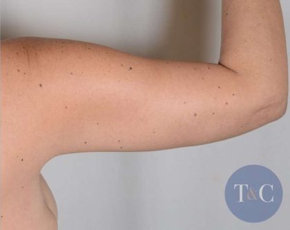 Arm Lift Before & After Patient #521