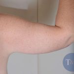 Arm Lift Before & After Patient #526
