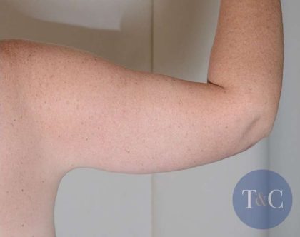 Arm Lift Before & After Patient #526
