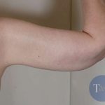 Arm Lift Before & After Patient #531