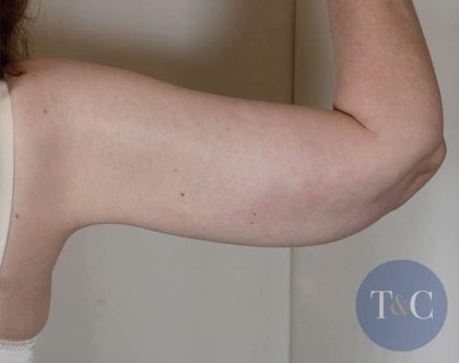 Arm Lift Before & After Patient #531
