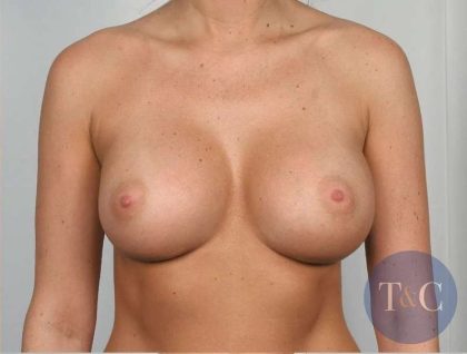 Breast Augmentation Before & After Patient #606