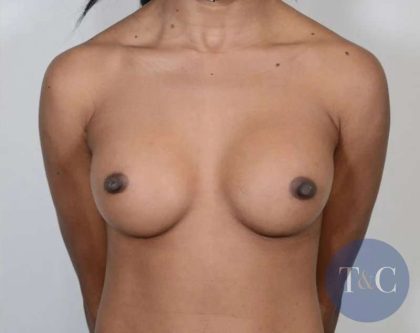 Breast Augmentation Before & After Patient #661