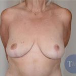 Breast Lift Before & After Patient #731