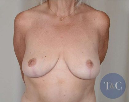 Breast Lift Before & After Patient #731