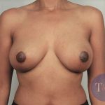 Breast Lift Before & After Patient #741
