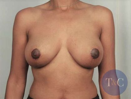 Breast Lift Before & After Patient #741