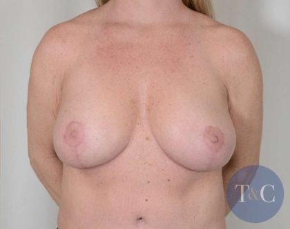 Breast Lift Before & After Patient #751