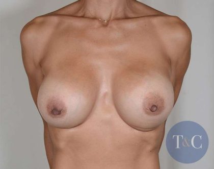 Breast Revision Before & After Patient #881