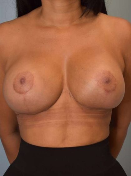 Breast Revision Before & After Patient #906