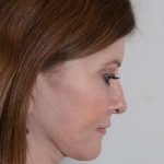 Facelift Before & After Patient #913