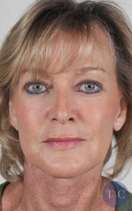 Facelift Before & After Patient #918
