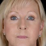 Facelift Before & After Patient #928