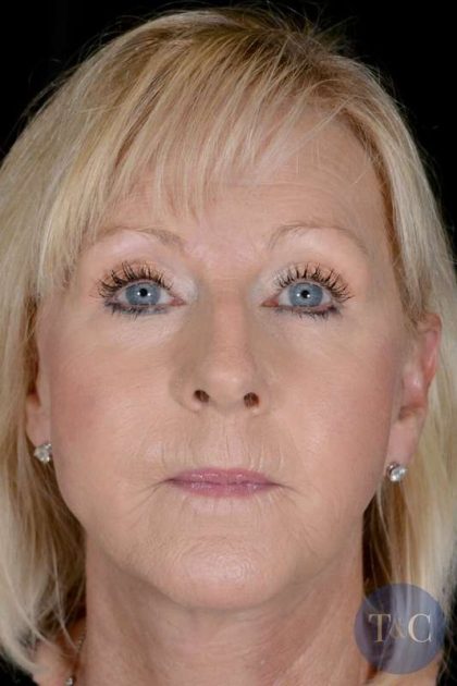 Facelift Before & After Patient #928