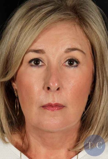 Facelift Before & After Patient #933