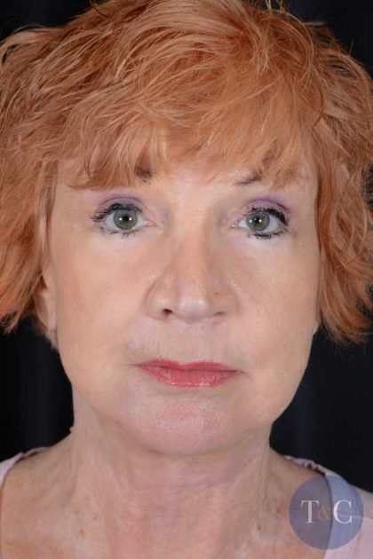 Facelift Before & After Patient #938