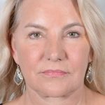 Facelift Before & After Patient #948