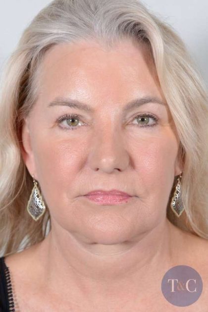 Facelift Before & After Patient #948
