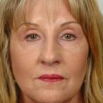 Facelift Before & After Patient #953