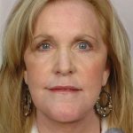 Facelift Before & After Patient #958