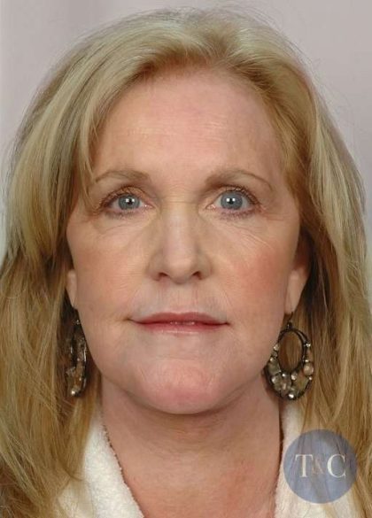 Facelift Before & After Patient #958