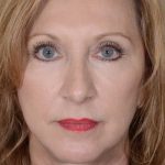 Facelift Before & After Patient #963