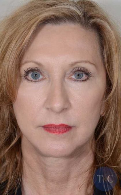 Facelift Before & After Patient #963