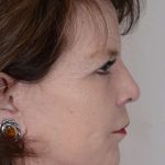 Facelift Before & After Patient #983