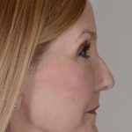 Facelift Before & After Patient #993
