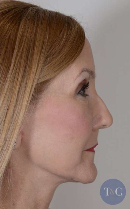 Facelift Before & After Patient #993