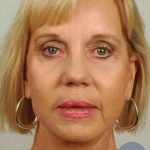 Facelift Before & After Patient #998