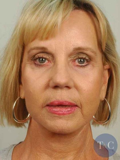 Facelift Before & After Patient #998