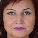 Facelift Before & After Patient #1003