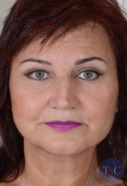Facelift Before & After Patient #1003