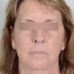 Facelift Before & After Patient #1008