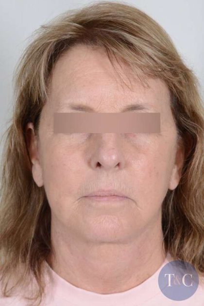 Facelift Before & After Patient #1008