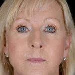 Facelift Before & After Patient #1018