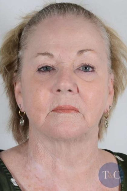 Facelift Before & After Patient #1023
