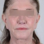 Facelift Before & After Patient #1028