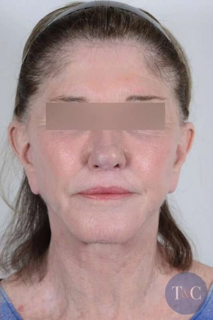 Facelift Before & After Patient #1028