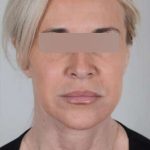 Facelift Before & After Patient #1033