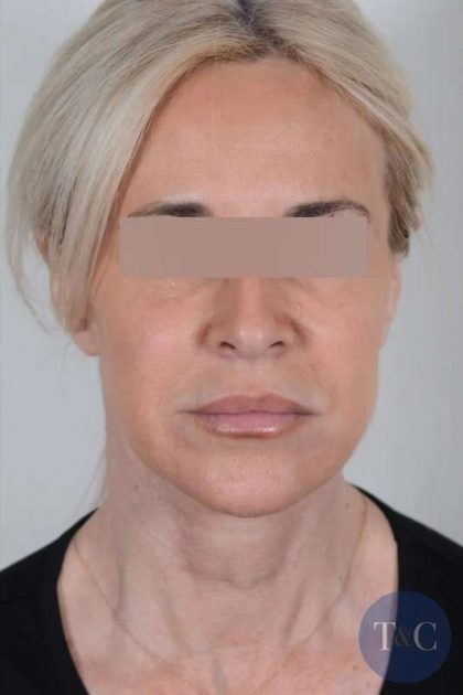 Facelift Before & After Patient #1033