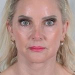 Facelift Before & After Patient #1038